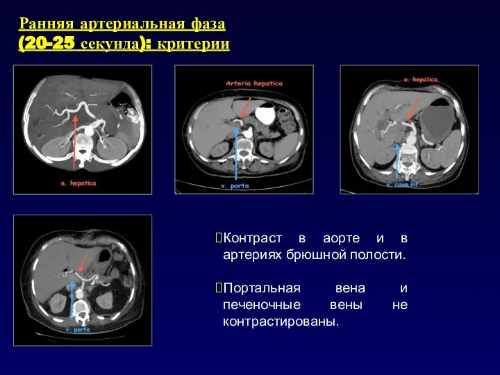 Ранняя артериальная фаза (20-25 секунда): критерии Контраст в аорте и в