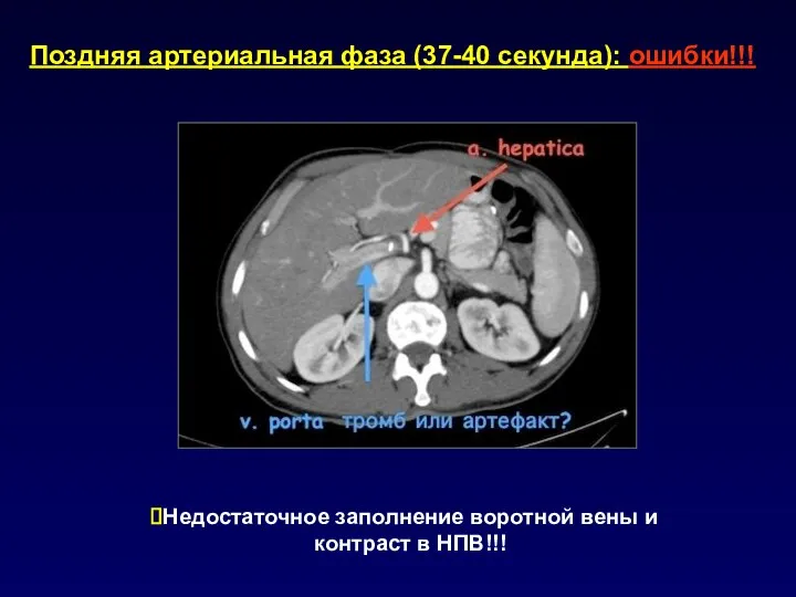 Поздняя артериальная фаза (37-40 секунда): ошибки!!! Недостаточное заполнение воротной вены и контраст в НПВ!!!
