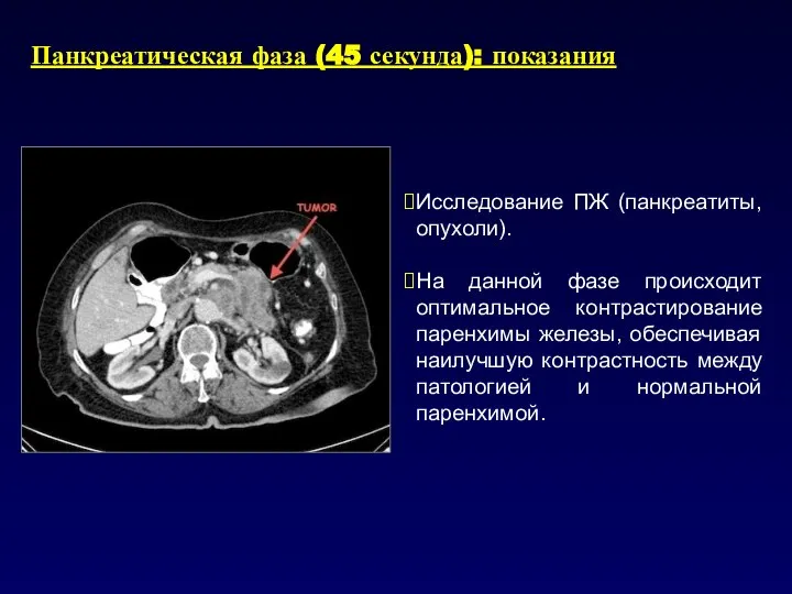 Панкреатическая фаза (45 секунда): показания Исследование ПЖ (панкреатиты, опухоли). На данной