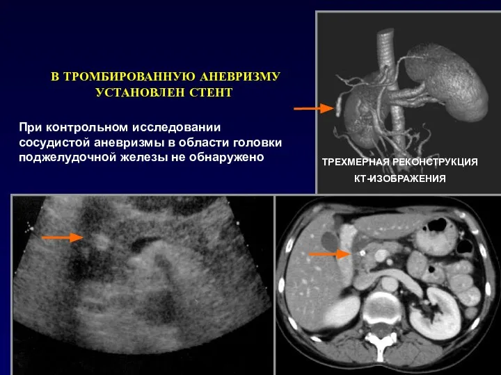 ТРЕХМЕРНАЯ РЕКОНСТРУКЦИЯ КТ-ИЗОБРАЖЕНИЯ В ТРОМБИРОВАННУЮ АНЕВРИЗМУ УСТАНОВЛЕН СТЕНТ При контрольном исследовании