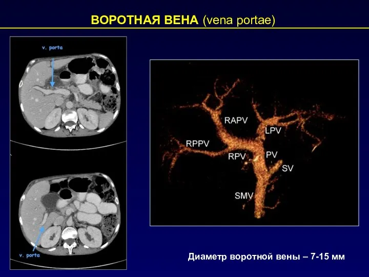 ВОРОТНАЯ ВЕНА (vena portae) Диаметр воротной вены – 7-15 мм