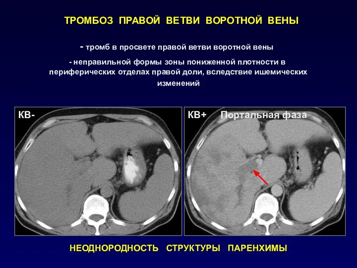 ТРОМБОЗ ПРАВОЙ ВЕТВИ ВОРОТНОЙ ВЕНЫ тромб в просвете правой ветви воротной