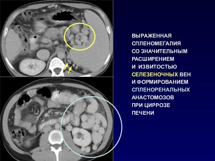 ВЫРАЖЕННАЯ СПЛЕНОМЕГАЛИЯ СО ЗНАЧИТЕЛЬНЫМ РАСШИРЕНИЕМ И ИЗВИТОСТЬЮ СЕЛЕЗЕНОЧНЫХ ВЕН И ФОРМИРОВАНИЕМ СПЛЕНОРЕНАЛЬНЫХ АНАСТОМОЗОВ ПРИ ЦИРРОЗЕ ПЕЧЕНИ