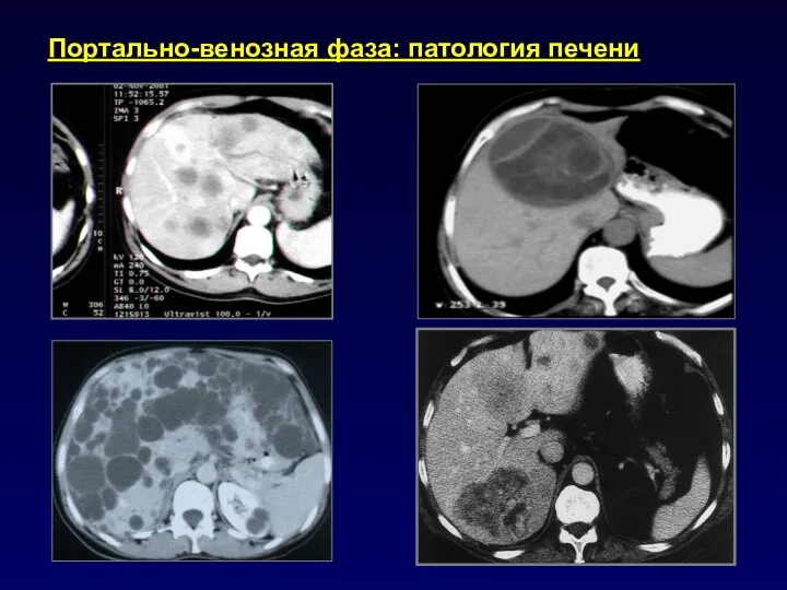 Портально-венозная фаза: патология печени