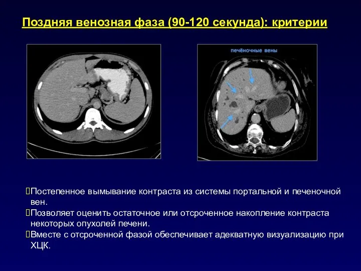 Поздняя венозная фаза (90-120 секунда): критерии Постепенное вымывание контраста из системы