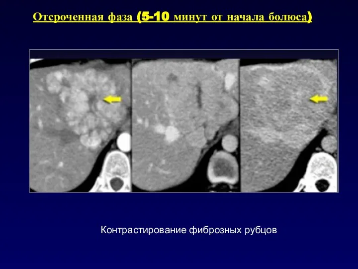 Отсроченная фаза (5-10 минут от начала болюса) Контрастирование фиброзных рубцов