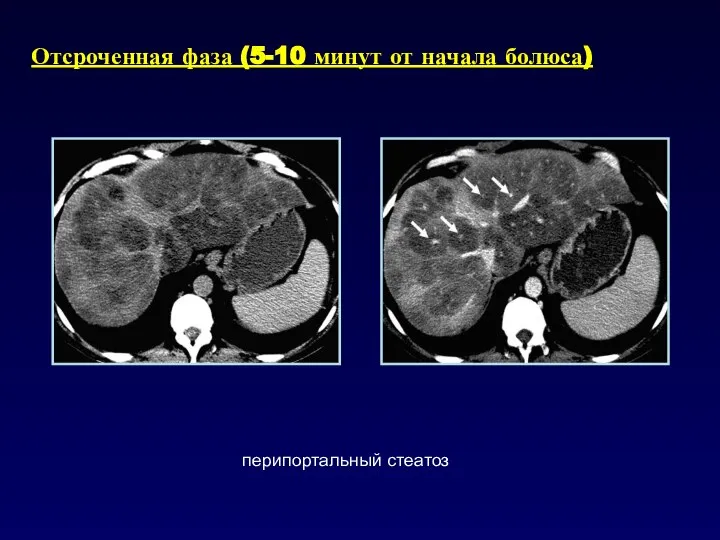 Отсроченная фаза (5-10 минут от начала болюса) перипортальный стеатоз
