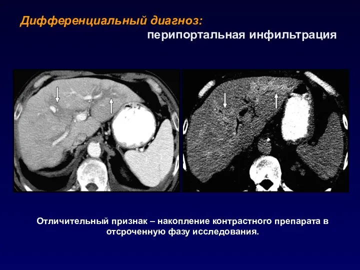 Дифференциальный диагноз: перипортальная инфильтрация Отличительный признак – накопление контрастного препарата в отсроченную фазу исследования.