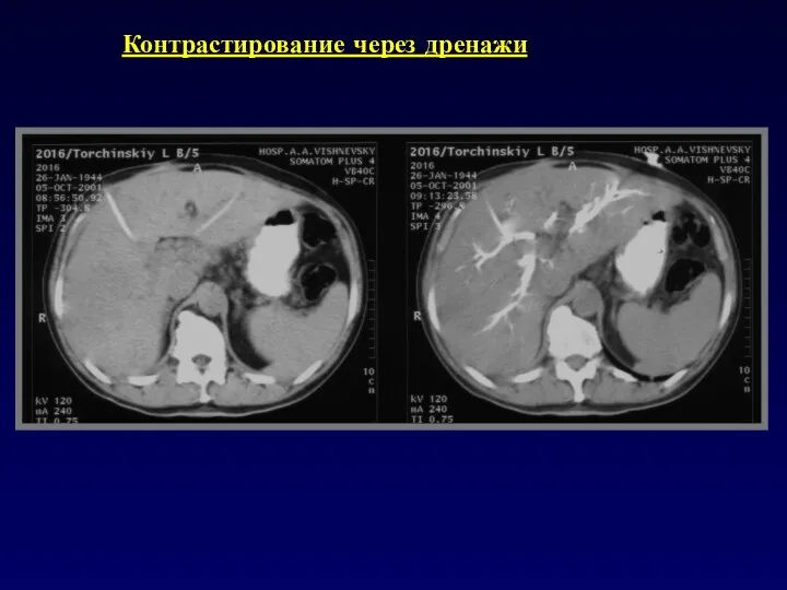 Контрастирование через дренажи