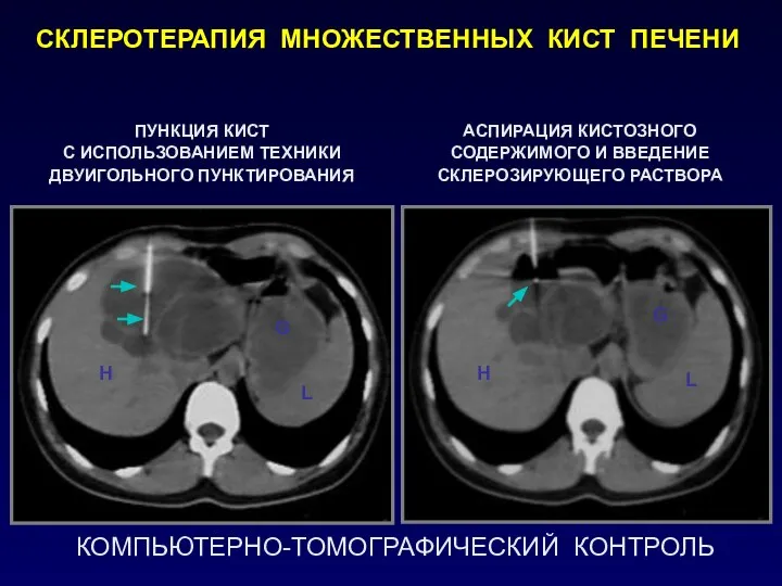 КОМПЬЮТЕРНО-ТОМОГРАФИЧЕСКИЙ КОНТРОЛЬ СКЛЕРОТЕРАПИЯ МНОЖЕСТВЕННЫХ КИСТ ПЕЧЕНИ ПУНКЦИЯ КИСТ С ИСПОЛЬЗОВАНИЕМ ТЕХНИКИ