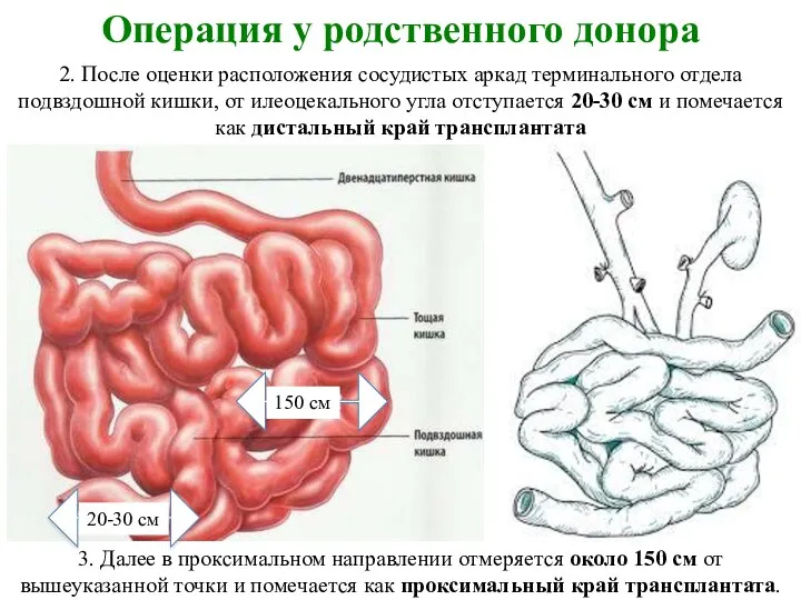 Операция у родственного донора 2. После оценки расположения сосудистых аркад терминального