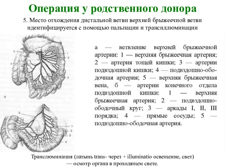 Операция у родственного донора 5. Место отхождения дистальной ветви верхней брыжеечной