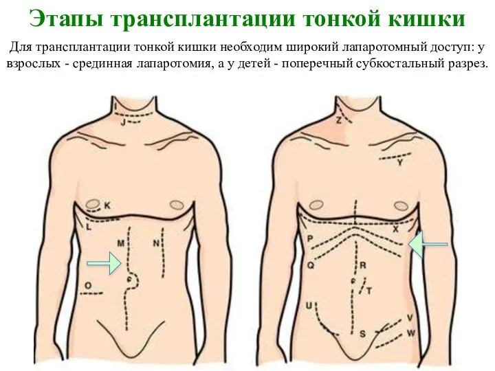 Этапы трансплантации тонкой кишки Для трансплантации тонкой кишки необходим широкий лапаротомный