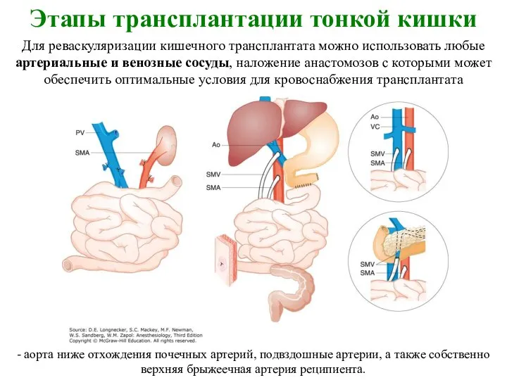 Этапы трансплантации тонкой кишки Для реваскуляризации кишечного трансплантата можно использовать любые