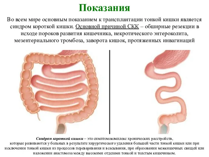 Показания Во всем мире основным показанием к трансплантации тонкой кишки является