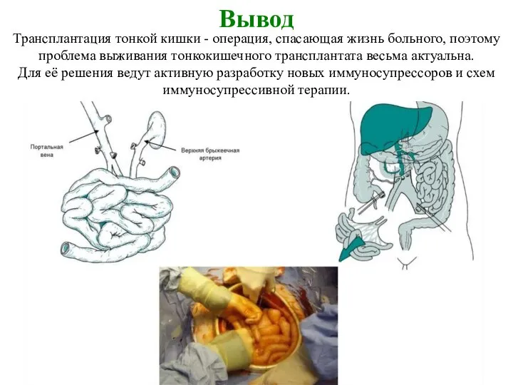 Вывод Трансплантация тонкой кишки - операция, спасающая жизнь больного, поэтому проблема