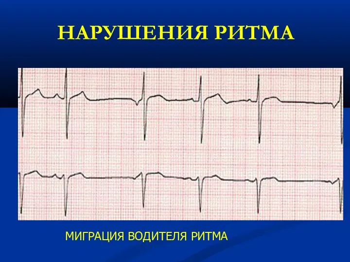 НАРУШЕНИЯ РИТМА МИГРАЦИЯ ВОДИТЕЛЯ РИТМА