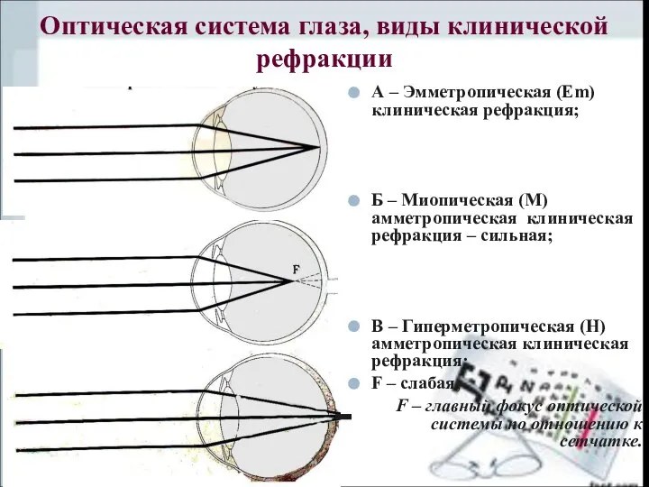 А – Эмметропическая (Em) клиническая рефракция; Б – Миопическая (М) амметропическая