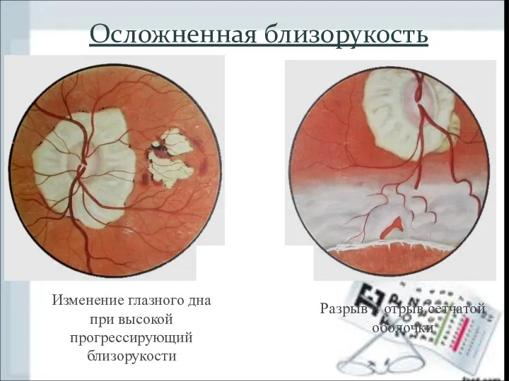 Осложненная близорукость Изменение глазного дна при высокой прогрессирующий близорукости Разрыв и отрыв сетчатой оболочки