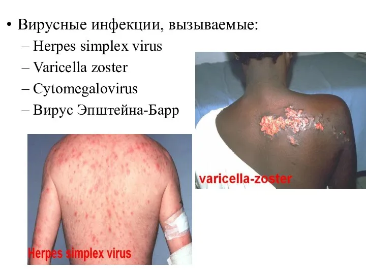 Вирусные инфекции, вызываемые: Herpes simplex virus Varicella zoster Cytomegalovirus Вирус Эпштейна-Барр