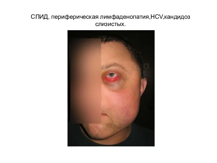 СПИД, периферическая лимфаденопатия,HCV,кандидоз слизистых.