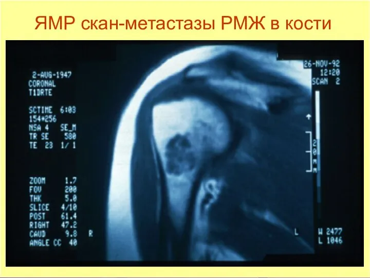 ЯМР скан-метастазы РМЖ в кости