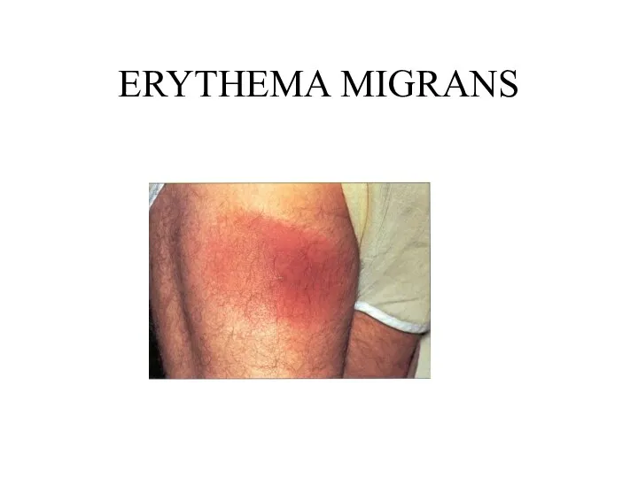 ERYTHEMA MIGRANS