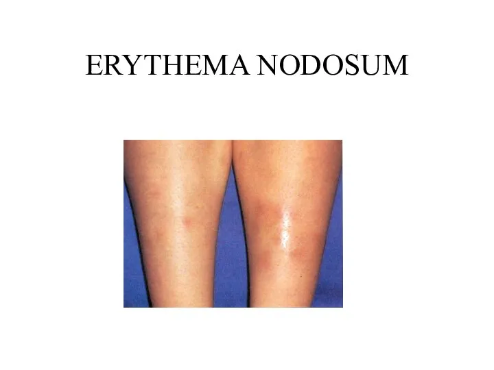 ERYTHEMA NODOSUM