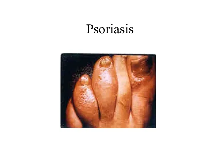 Psoriasis