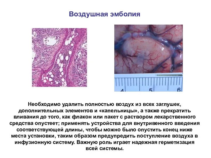 Воздушная эмболия Необходимо удалить полностью воздух из всех заглушек, дополнительных элементов