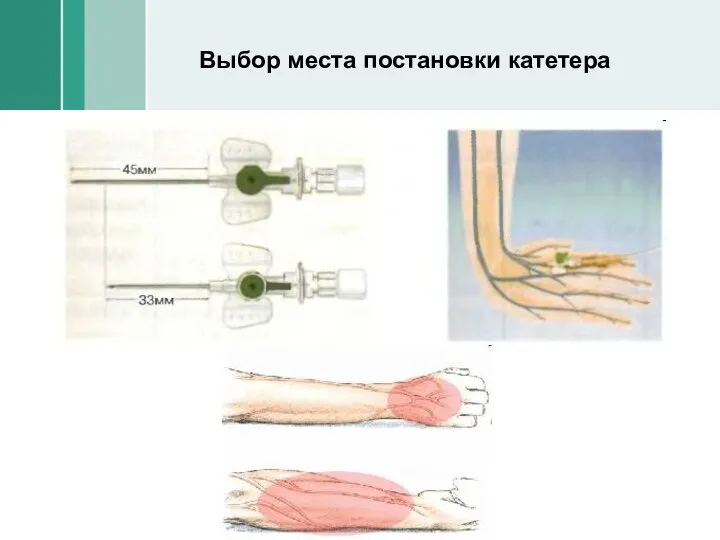 Выбор места постановки катетера