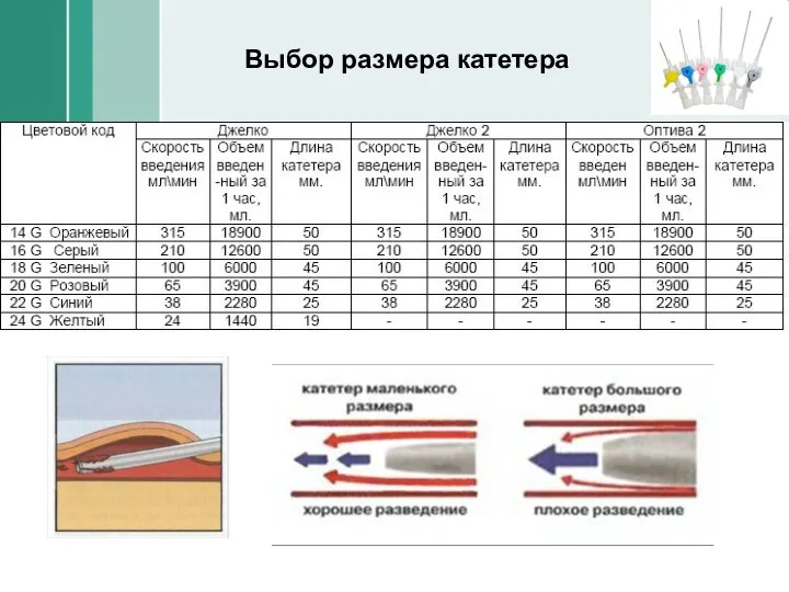 Выбор размера катетера