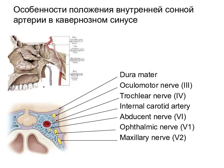 Особенности положения внутренней сонной артерии в кавернозном синусе Dura mater Oculomotor