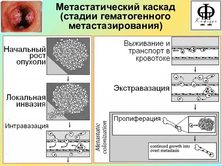 Метастатический каскад (стадии гематогенного метастазирования)