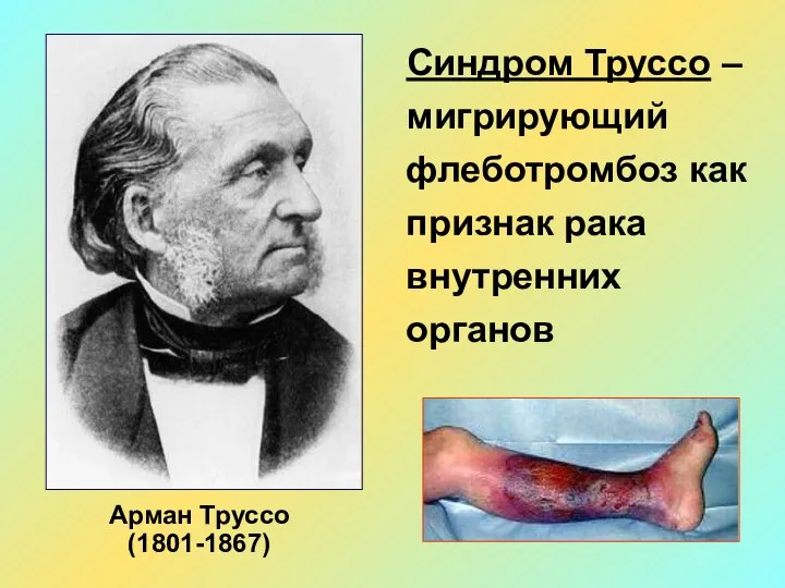 Арман Труссо (1801-1867) Синдром Труссо – мигрирующий флеботромбоз как признак рака внутренних органов