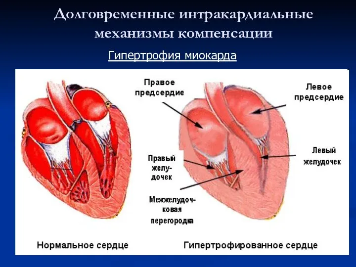 Долговременные интракардиальные механизмы компенсации Гипертрофия миокарда