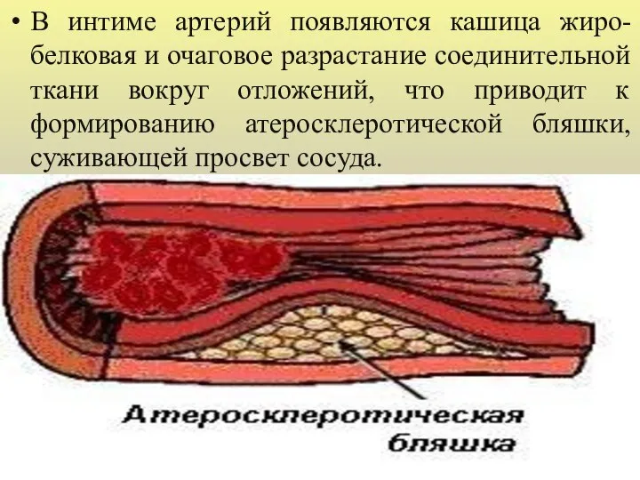 В интиме артерий появляются кашица жиро-белковая и очаговое разрастание соединительной ткани