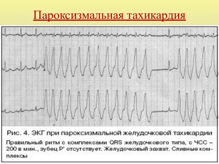 Пароксизмальная тахикардия