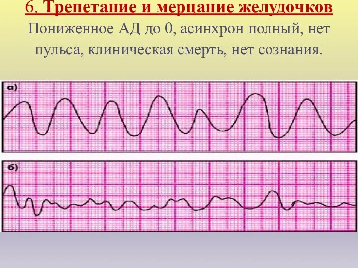 6. Трепетание и мерцание желудочков Пониженное АД до 0, асинхрон полный,