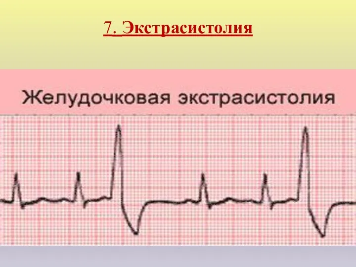 7. Экстрасистолия