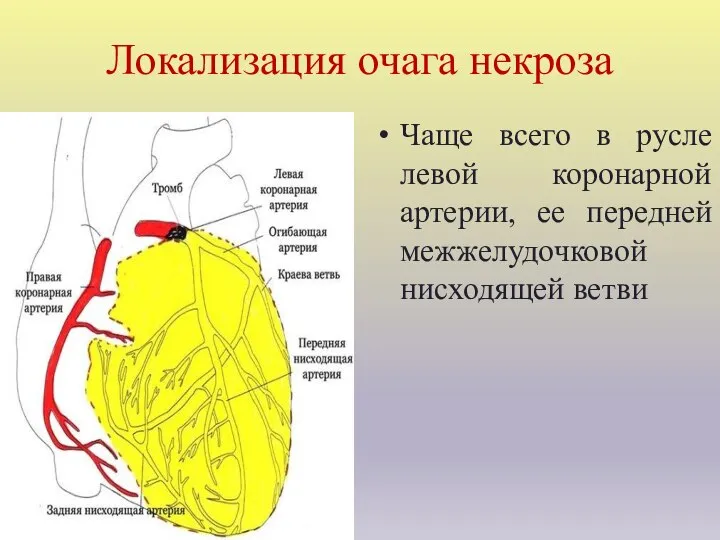 Локализация очага некроза Чаще всего в русле левой коронарной артерии, ее передней межжелудочковой нисходящей ветви