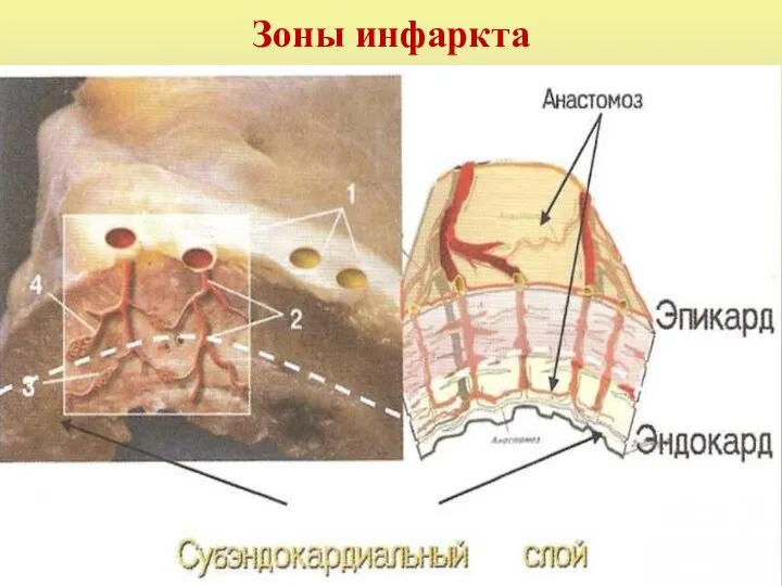 Зоны инфаркта