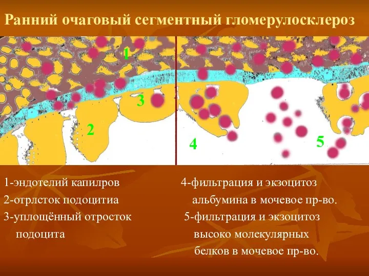 Ранний очаговый сегментный гломерулосклероз 1-эндотелий капилров 4-фильтрация и экзоцитоз 2-отрлсток подоцитиа