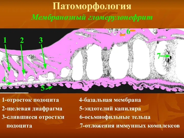 Патоморфология Мембранозный гломерулонефрит 1-отросток подоцита 4-базальная мембрана 2-щелевая диафрагма 5-эндотелий капиляра