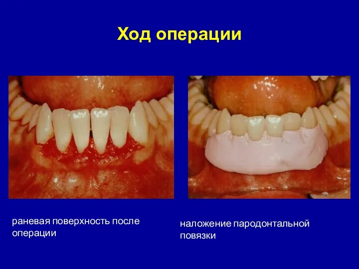 раневая поверхность после операции наложение пародонтальной повязки Ход операции