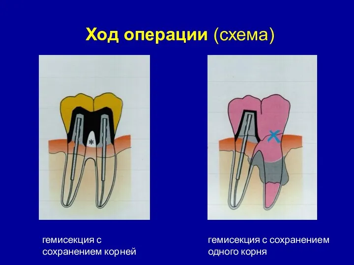 гемисекция с сохранением корней гемисекция с сохранением одного корня Ход операции (схема)