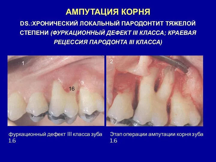 АМПУТАЦИЯ КОРНЯ DS.:ХРОНИЧЕСКИЙ ЛОКАЛЬНЫЙ ПАРОДОНТИТ ТЯЖЕЛОЙ СТЕПЕНИ (ФУРКАЦИОННЫЙ ДЕФЕКТ III КЛАССА;