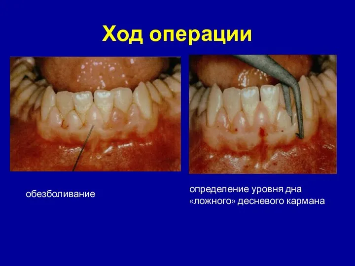 Ход операции обезболивание определение уровня дна «ложного» десневого кармана