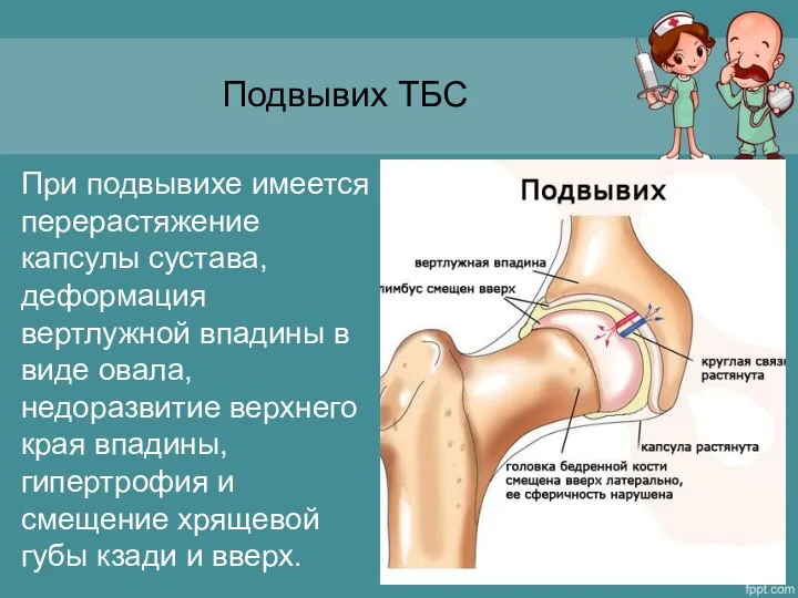 Подвывих ТБС При подвывихе имеется перерастяжение капсулы сустава, деформация вертлужной впадины