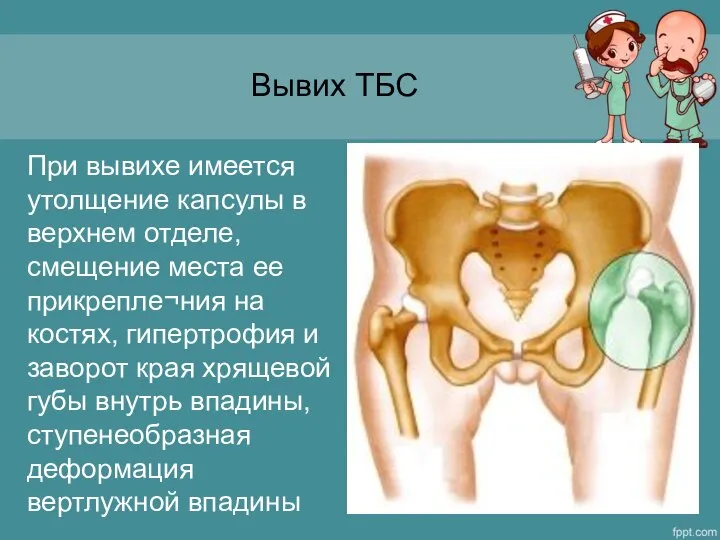 Вывих ТБС При вывихе имеется утолщение капсулы в верхнем отделе, смещение